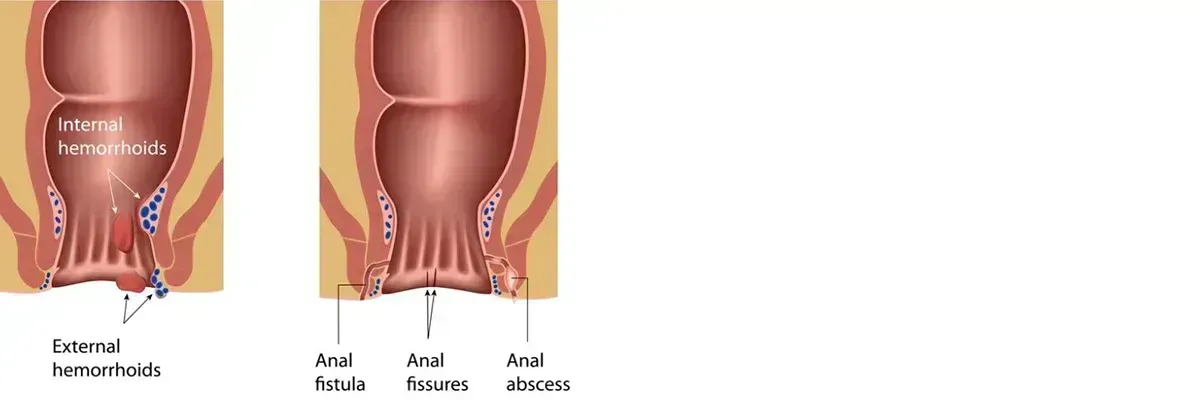 HEMORRHOIDS AND FISSURES